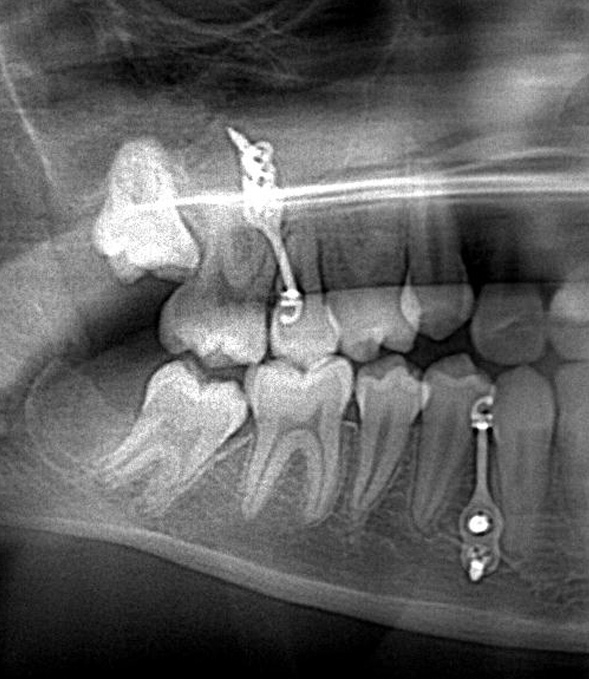 Les vis d'ancrage en orthodontie - Dr Chpindel, Orthodontiste